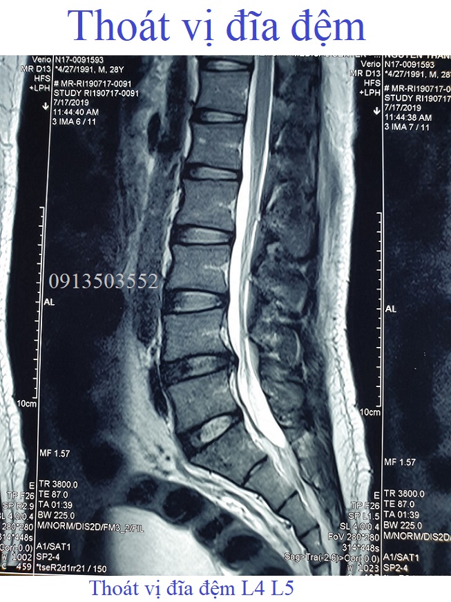 Bệnh thoát vị đĩa đệm